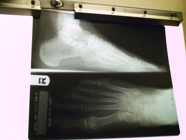 An image of a n X-Ray of a person’s right foot.