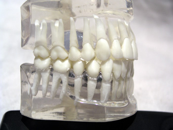 Teeth affixed on a plastic model of a human jaw